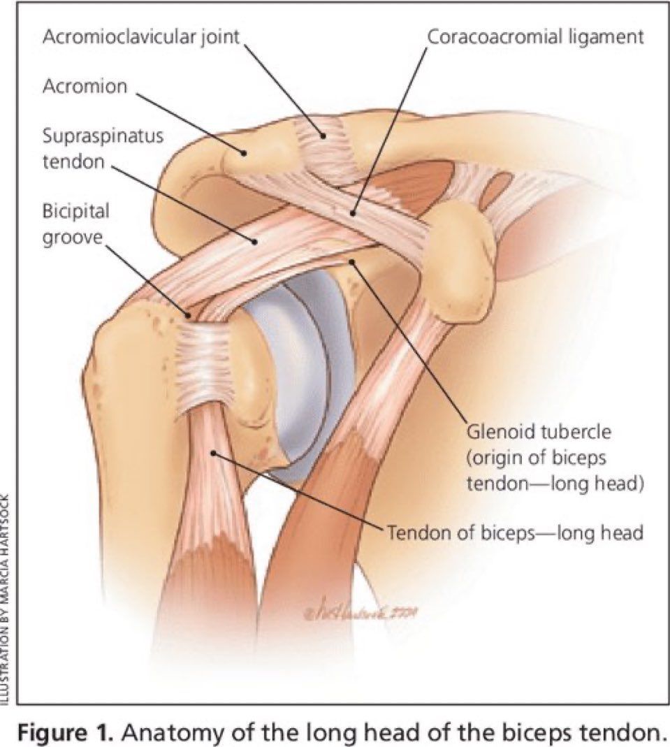 MoAImam's tweet image. Anatomy of the long head of the biceps tendon (LHBT)👇🏼
pubmed.ncbi.nlm.nih.gov/19725488/
#anatomy #biceps