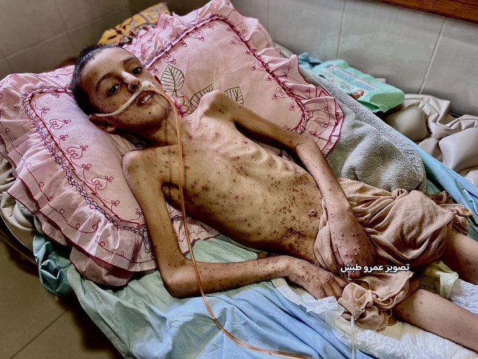 Obaida al Qarra, a child from Gaza..
A shrapnel from the criminal occupation forces penetrated into his skull..
It left him completely paralyzed, deaf and blind..
He suffers from recurrent seizures and a constant high fever..
Now, he’s facing hunger and severe malnutrition..
He