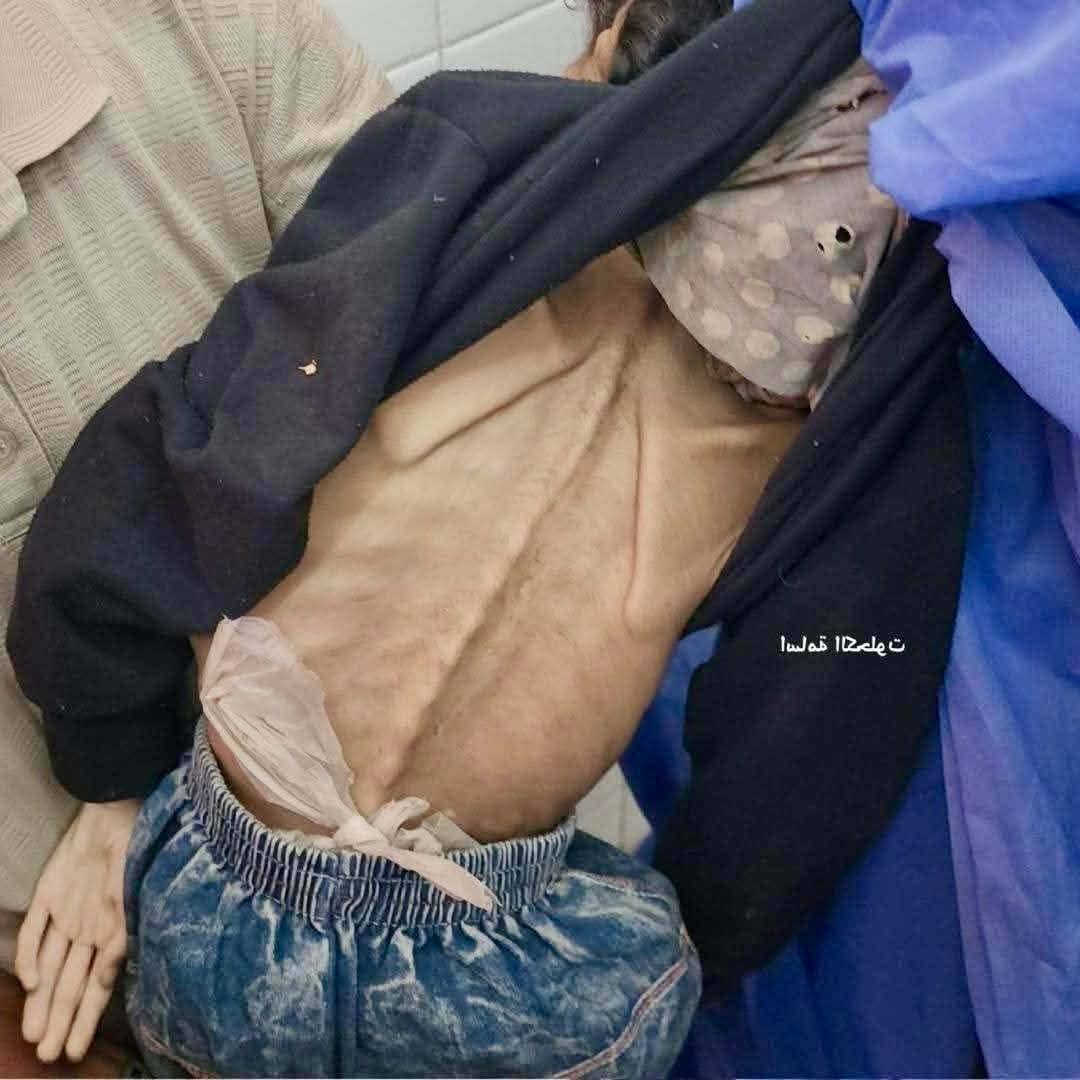 وفاة الطفلة نور أبو سلعة، 10 سنوات، بسبب سوء تغذية حاد😢🇵🇸 
بسبب الحصار والتجويع الذي يفرضه الاحتلال على غزة.