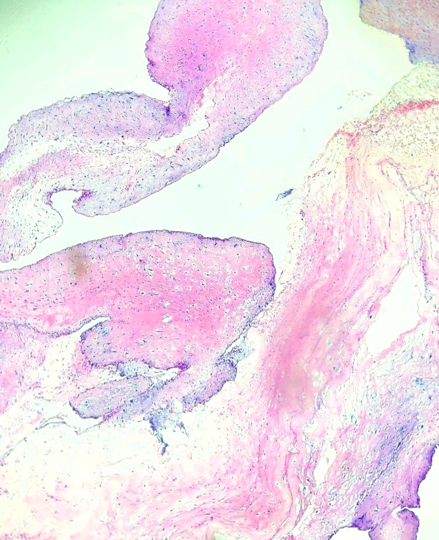 thejourneymate's tweet photo. Left Atrial Myxoma causing Acute Ischemic Stroke in an 8 year old girl.

Atrial myxomas are uncommon in the pediatric population but are very important due to pursuant atrioventricular valve obstruction and systemic embolic events. 
#cardiacpath #CVpath
🔬♥️ https://t.co/oqed9JiFSC