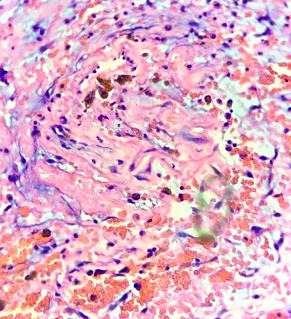 Left Atrial Myxoma causing Acute Ischemic Stroke in an 8 year old girl.

Atrial myxomas are uncommon in the pediatric population but are very important due to pursuant atrioventricular valve obstruction and systemic embolic events. 
#cardiacpath #CVpath
🔬♥️