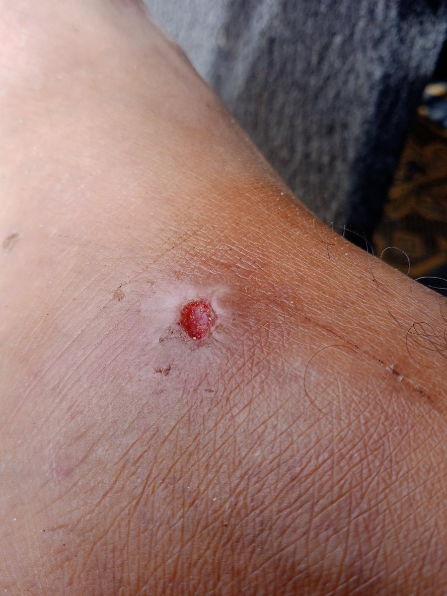 mohamadhas57977's tweet image. This is my injury from the occupation bullets, and I was going to humanitarian aid when they shot at us. Where is the humanity in that? We want to bring food. Help me to buy food and medicine. Please do not hesitate to help me.chuffed.org/project/134400…