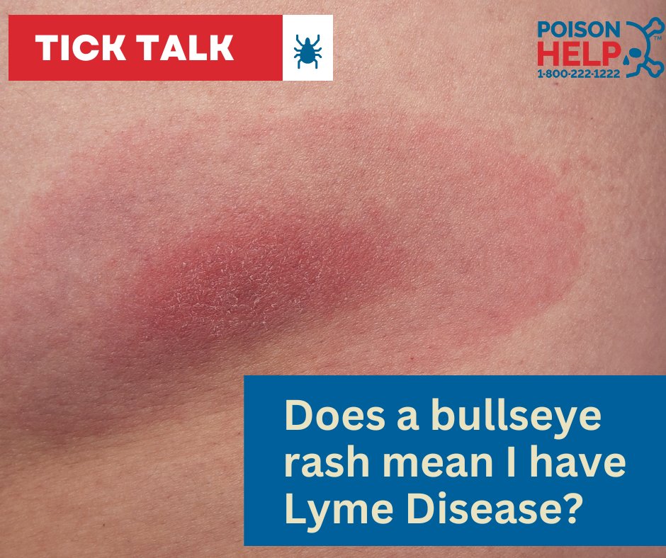 NTXPoisonCenter's tweet photo. 🎯 Bullseye ≠ Lyme disease! Not every ring-shaped rash means Lyme. Bug bites and irritations can look similar. 🕷️ Unsure? 📞 Call 1-800-222-1222 anytime—no cost, no judgment. #LymeDiseaseAwareness #TickBites #BullseyeMyth #PoisonHelp #NTPC #CallUsFirst #KnowTheSigns https://t.co/RD0dHqdI8z