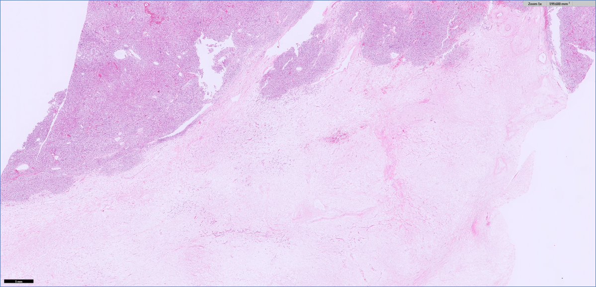#GUpath #grosspath correlation:

myxoid degeneration in nephrectomy of clear cell RCC

🚨👁️gross &amp; histologic🔬mimic of tumor cell necrosis (an important poor prognostic factor for clear cell RCC)
