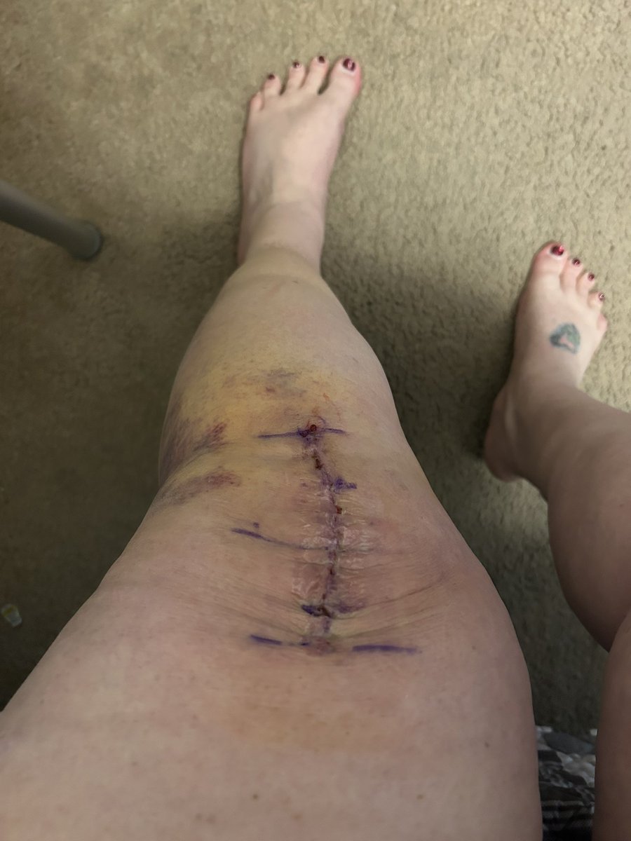 Daflippityflop1's tweet image. First look of my knee. Exactly 7 days ago