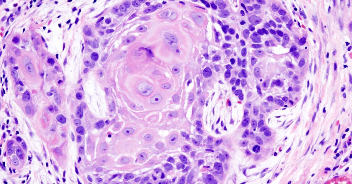 UCSDMedSchool's tweet image. Breakthrough in head and neck cancer treatment: Precise timing of radiation & immunotherapy boosts immune response, says study from researchers at @ucsdmedschool and @UCSDCancer. Results could reshape treatment for aggressive tumors.
Read ➡️ go.ucsd.edu/4lSAqe9
