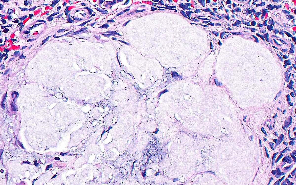 🔬📷 Uromodulin Cast ~ Pale and irregularly shaped cast material with "frothy" appearance, and surrounded by inflammation (due to extravasation) ~ #RenalPath #Pathology #Kidney