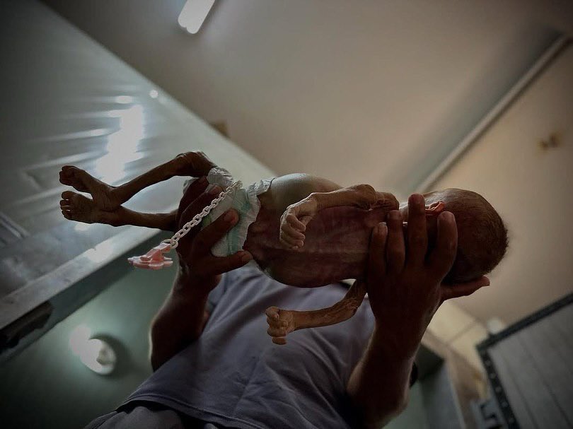 EyeonPalestine's tweet photo. Heartbreaking I She didn't live to see her first birthday... Baby Zainab Abu Hulaib succumbed to a hunger that showed no mercy to her fragile infancy, as the siege slowly drained her tiny body.
In her mother's arms, Zainab slipped away in silence - yet another witness to the crime of starvation claiming the children of Gaza.

لم تُكمل عامها الأول... الطفلة زينب أبو حليب استسلمت لجوع لم ترحمه
طفولتها، بعدما أنهك الحصار جسدها الصغير.
بين أذرع أمها، رحلت زينب بصمت، شاهدة جديدة على جريمة التجويع
التي تحاصر أطفال غزة حتى الم وت