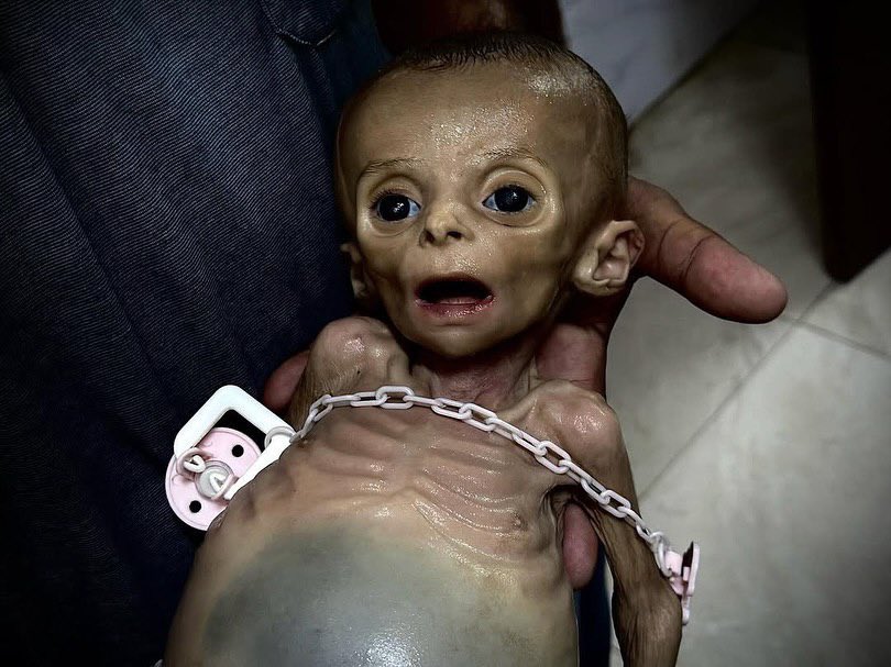 Heartbreaking I She didn't live to see her first birthday... Baby Zainab Abu Hulaib succumbed to a hunger that showed no mercy to her fragile infancy, as the siege slowly drained her tiny body.
In her mother's arms, Zainab slipped away in silence - yet another witness to the
