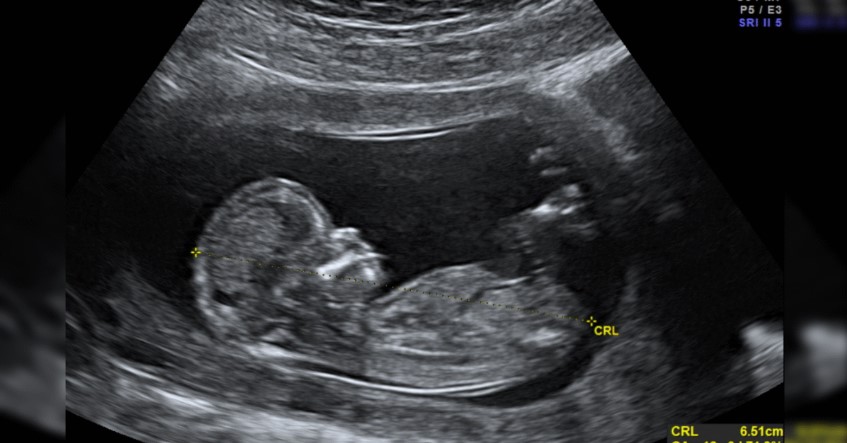 Texas Father Sues California Doctor for Wrongful Death of his Unborn Children in Landmark Abortion Pill Case

A Texas physician mailed abortion-inducing drugs into Texas that were used to murder Jerry Rodriguez’s unborn child.

We have a federal judge who has determined that