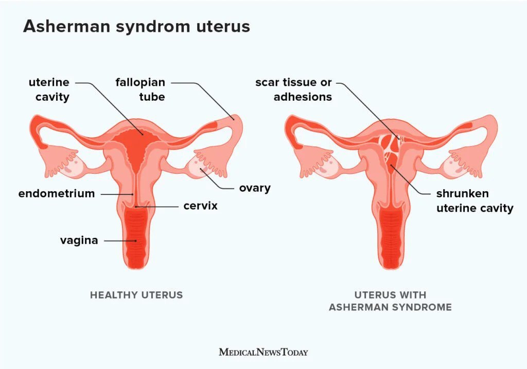 Uterine adhesion is best visualised through saline infusion sonography.

By introducing normal saline into the endometrium,  the cavity becomes distended showing hyper to hypoechoic bands crossing from anterior to Posterior endometrial wall.
Can cause infertility.
