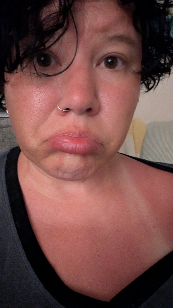 Lisa forgot her sunscreen before jumping in the pool for three hours. 🥵🔥😭