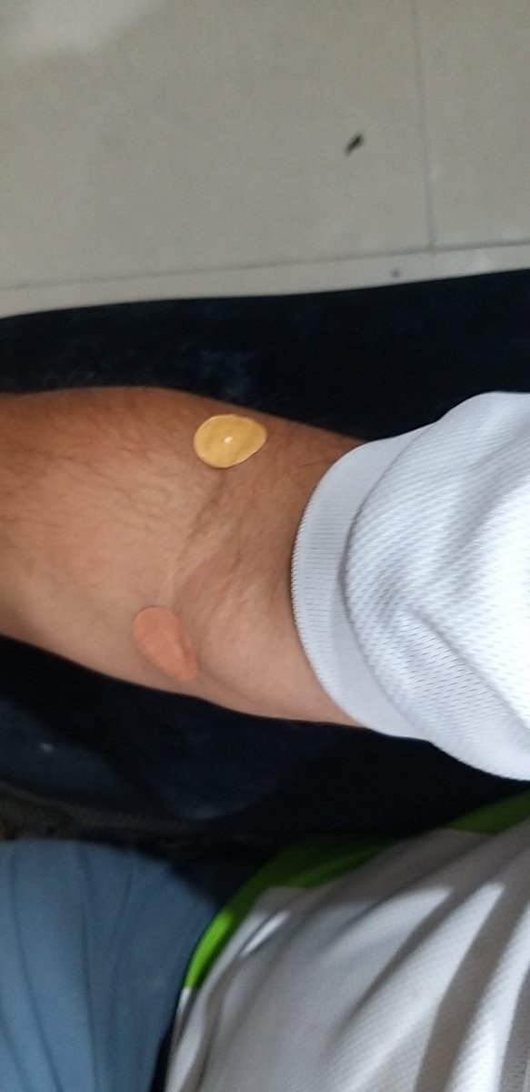 saneyedoc1's tweet image. Private #Phlebotomist #Homecollection
Questionable technique, Never ever before.
I got pricked thrice this morning 
@tms44076298 @malviyapankaj @malpani @swaraj76 @anil_lulla @NalinisKitchen @chetanabelagere  - need to explore how these people are being audited