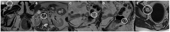 JCM_MDPI's tweet image. #mdpijcm
👏Citations 5 
2025 Review Paper
#computed_tomography
#radiology
📖Node Reporting and Data System 1.0 (Node-RADS) for the Assessment of Oncological Patients’ Lymph Nodes in #ClinicalImaging
by Marco Parillo et al. 
🖇️mdpi.com/3120834
@MediPharma_MDPI
 @UniTrento