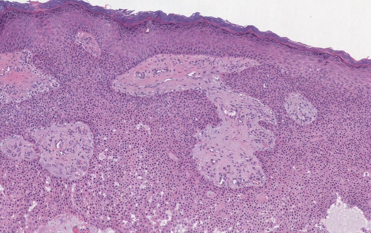 55-yo man with a solitary red nodule on the sole. Biopsy revealed a tumor with epidermal connection, composed of uniform cuboidal poroid cells ➡️ Poroma 
#dermatology