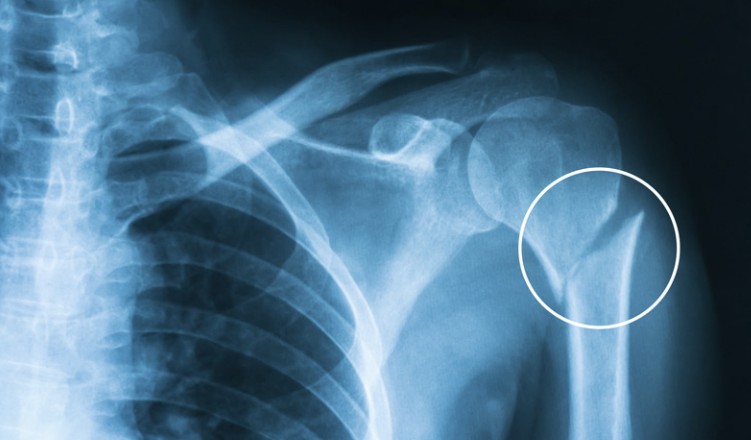 Danny Mills (@dannymills_1) on Twitter photo I'm going to be blunt with you all i may be out for a while. Just got news from the <a href="/IWFUniverse/">IWF on Twitch</a> medical and its not looking to good for me. They told me i have a humerus fracture and it may take up to 6 months or more to heal up. I'll be back asap. Sorry again... #IWFCITS I'm going to be blunt with you all i may be out for a while. Just got news from the <a href="/IWFUniverse/">IWF on Twitch</a> medical and its not looking to good for me. They told me i have a humerus fracture and it may take up to 6 months or more to heal up. I'll be back asap. Sorry again... #IWFCITS