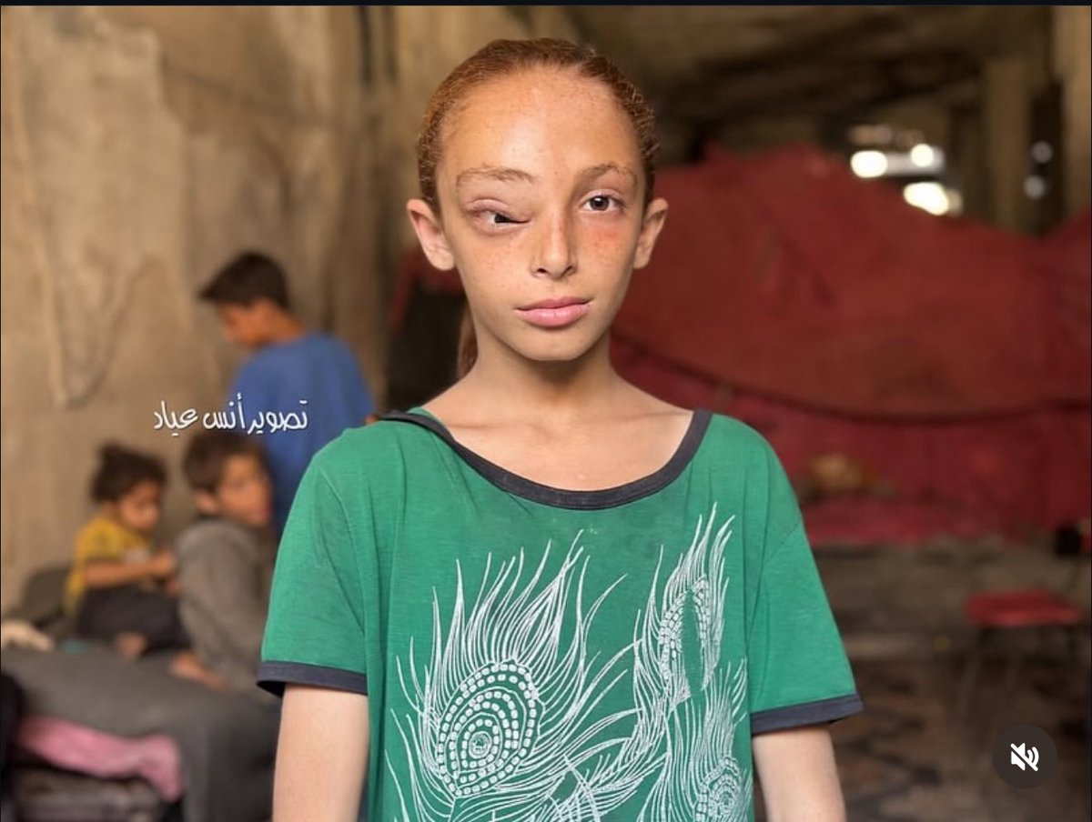 This is Sarah Mohammed Said Badra, a displaced child from Jabalia, Gaza.
She is suffering from a severe tumor in her head and eye caused by cancer. Her treatment stopped entirely after the collapse of Gaza’s healthcare system.

Sarah also lives with a dangerous food allergy, but