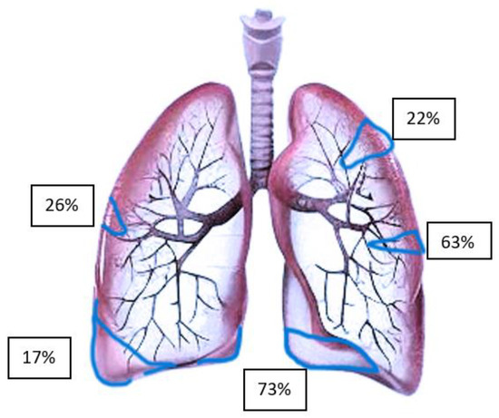 JCM_MDPI's tweet image. #mdpijcm
#HighlyReviewed
👏Views 15542, Citations 9
#Pulmonary_Embolism in #Pregnancy: A Review for Clinical Practitioners
by Agata Makowska et al. 
👉mdpi.com/2787020
@MediPharma_MDPI
🏬Cantonal Hospital Lucerne
Hospital Centre of Biel