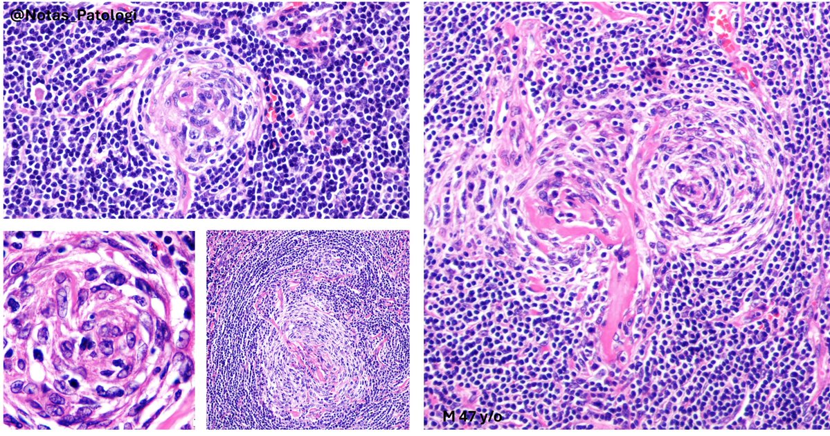 🧬 CASTLEMAN DISEASE – HYALINE-VASCULAR VARIANT (UCD-HV): WHAT EVERY PATHOLOGIST SHOULD KNOW

The unicentric hyaline-vascular variant of Castleman disease (UCD-HV) is the most common and typically benign form of this heterogeneous group of lymphoproliferative disorders. Despite