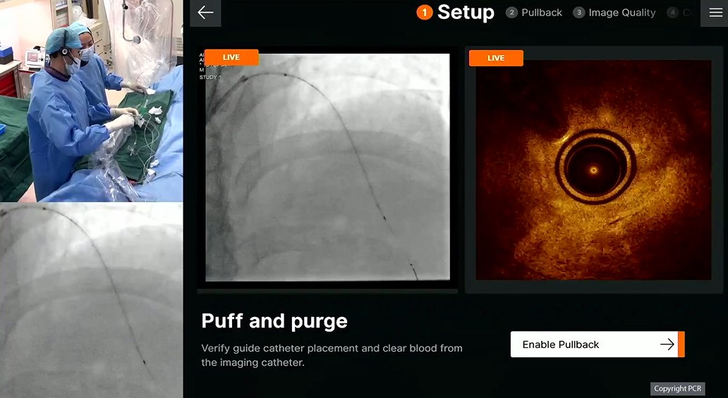 PCRonline's tweet image. Stent and paclitaxel DCB on mid and distal LAD guided by OCT
📺pcronline.com/Cases-resource…
(access via your free My PCR account)
Learn from the the replay of this LIVE educational case regarding a hybrid procedure: Stent and DCB 🎈 for a long diffuse lesion
Key 🔑 moments:…