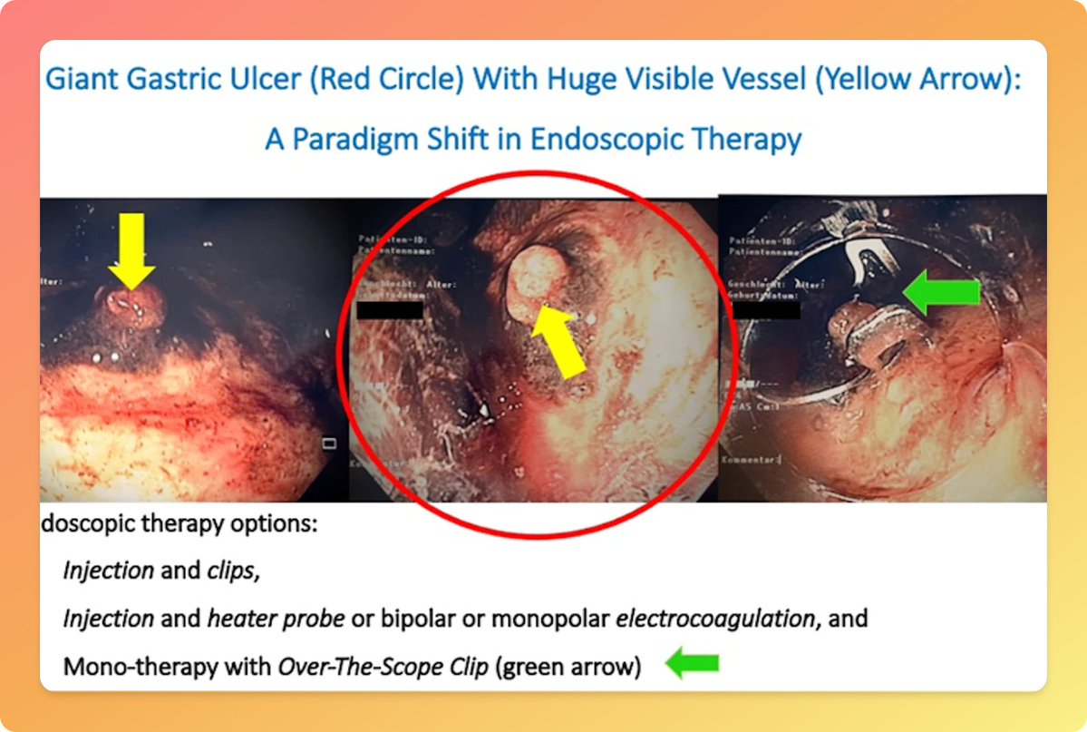 EndoCollabcom's tweet image. Mono-Endoscopic Therapy for Peptic Ulcer Bleeding