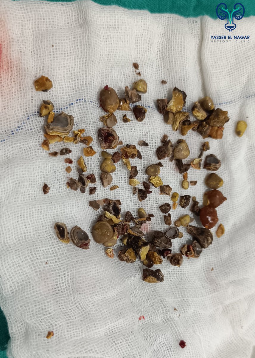 🎗️High located Rt kidney.
🎗️ Lower calyx punctured through supracostal (above 12th rib) .
🎗️Middle calyx punctured through supracostal (above 11th rib).
🎗️I was lucky enough to reach upper calyx through middle clayx and i didn't need another upper calyceal puncture 😅.