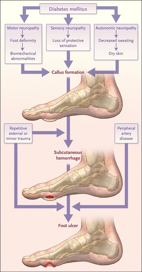 DGArmstrong's tweet image. Common Pathway of Diabetic Foot Ulcer Occurence and Recurrence @NEJM nejm.org/doi/full/10.10…