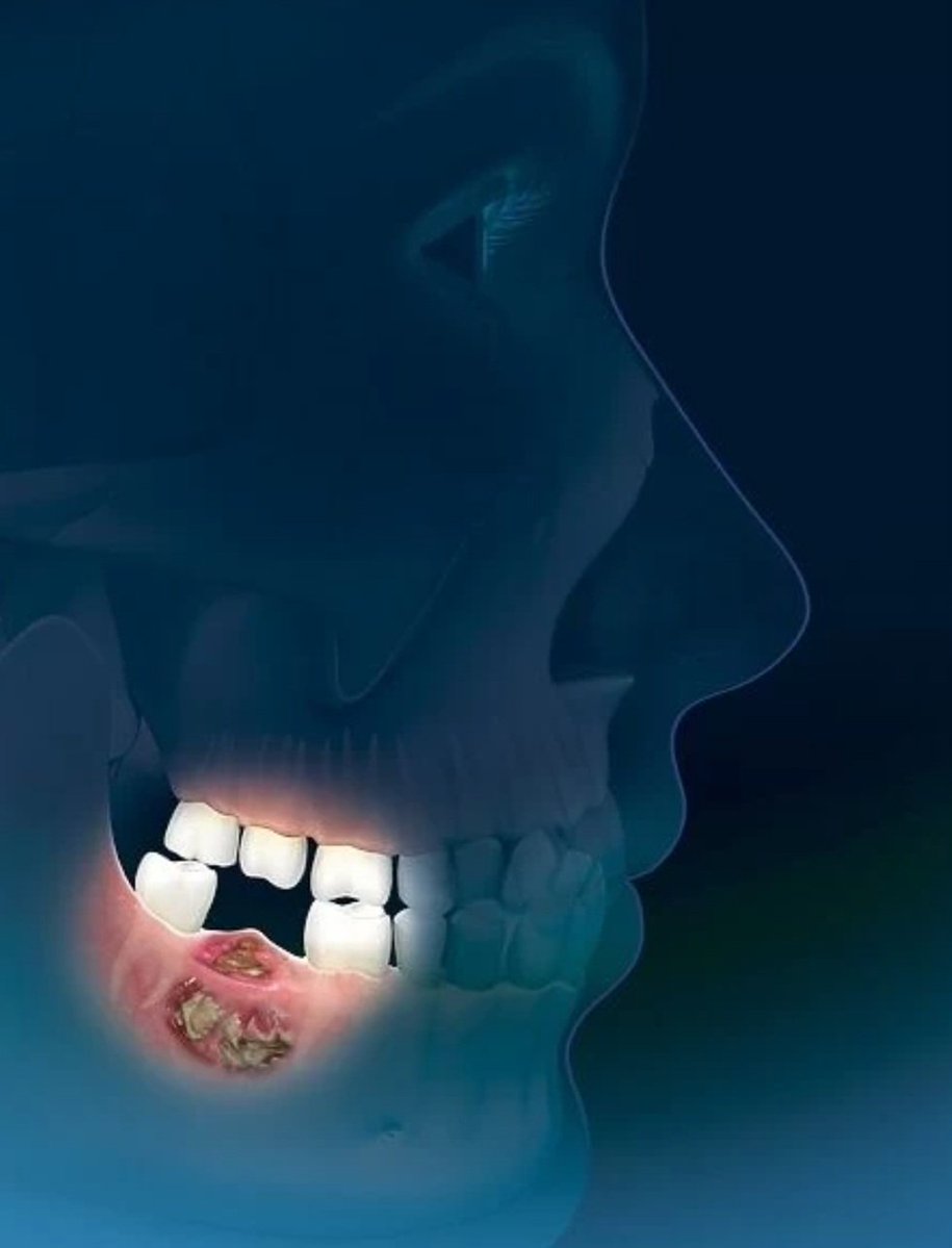 AlshammariOMFS's tweet image. للزملاء الذين سيصفون لمرضاهم أدوية البيسفوسفونات (Bisphosphonates)
يجب فحص كامل فم المريض وعلاجه، ...قبل البدء في هذه الأدوية..
ولمن يخضعون لهذه الأدوية -عافاهم الله-
يجب إخبار طبيب الأسنان قبل البدء بأي علاج للأسنان..
"لعدم حدوث مضاعفات نخر في عظم الفك"