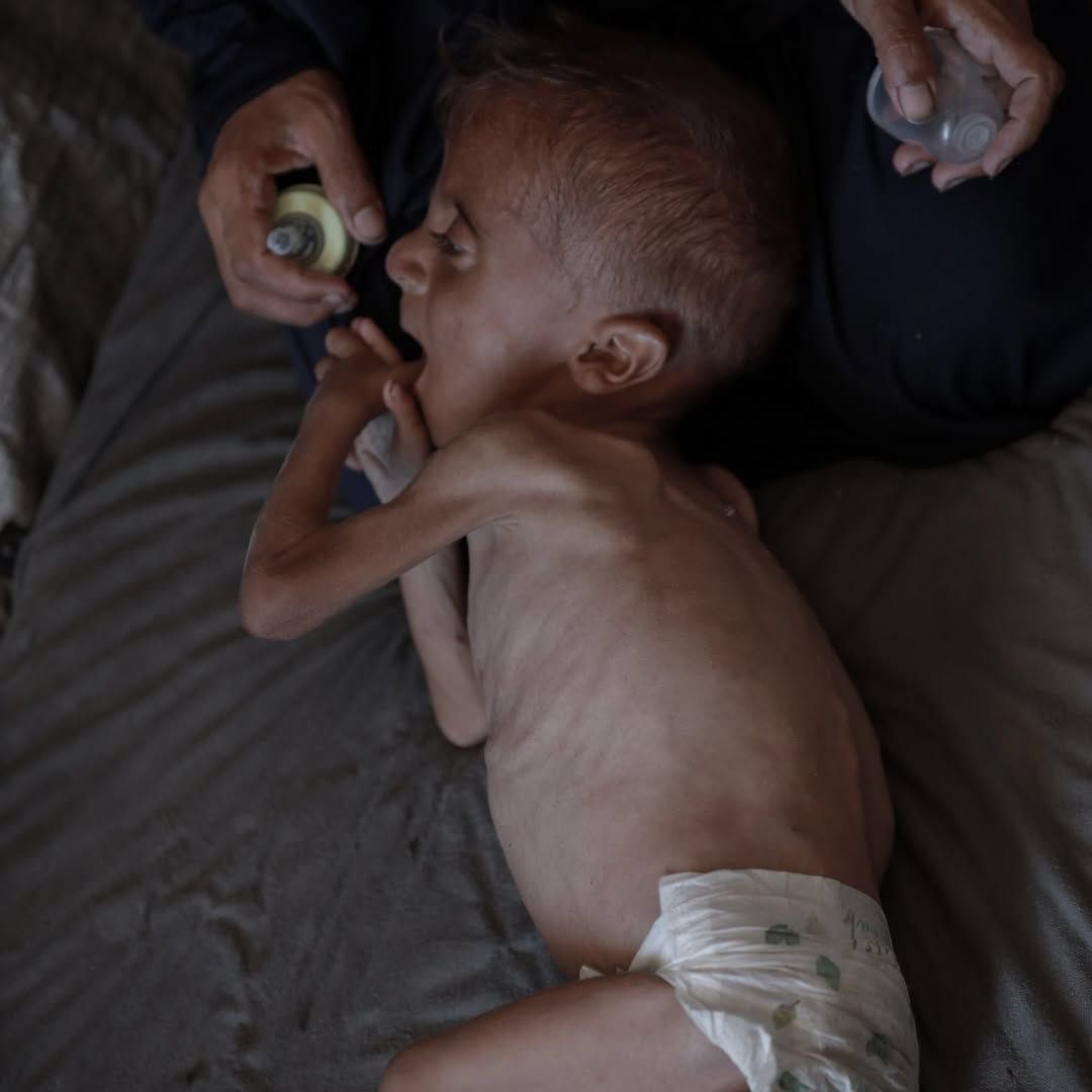 DmodosCutter's tweet image. 3-year-old Mohammad Al-Mutawwaq is suffering from acute malnutrition due to the runout of essential supplies in Gaza amid the ongoing Israeli blockade on the region.
#OpenBorders4AidNow