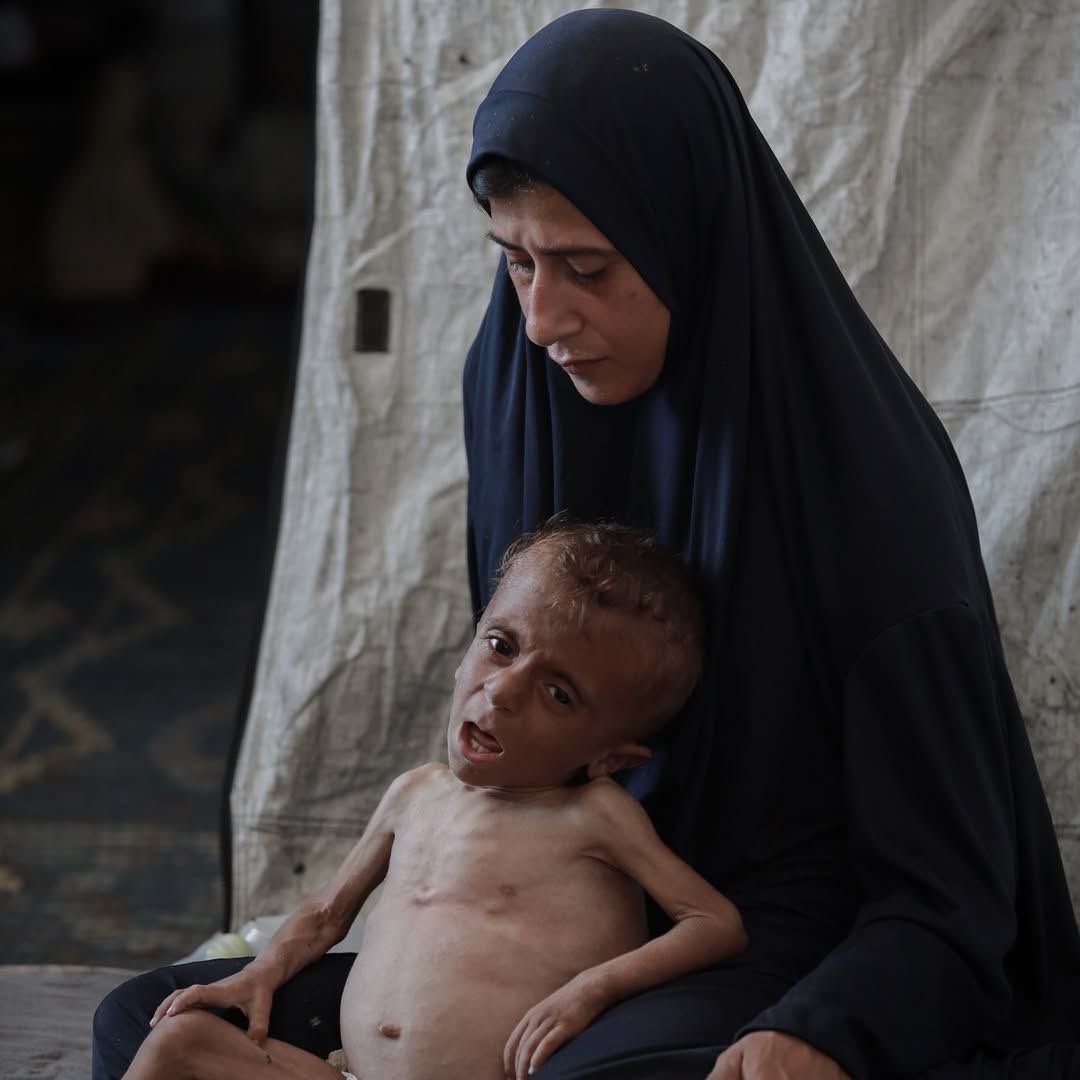 DmodosCutter's tweet image. 3-year-old Mohammad Al-Mutawwaq is suffering from acute malnutrition due to the runout of essential supplies in Gaza amid the ongoing Israeli blockade on the region.
#OpenBorders4AidNow