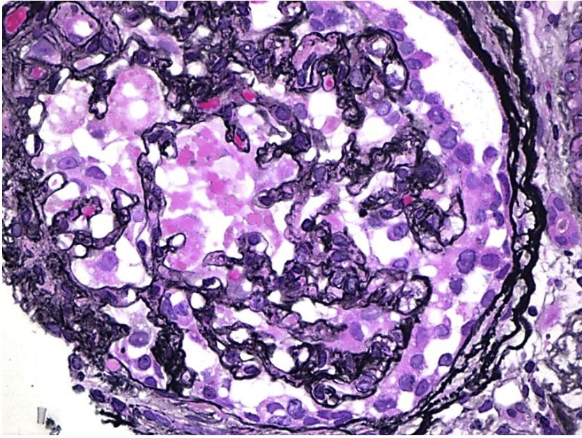 AJKDonline's tweet image. #RenalPath: The collapsing pattern in collapsing glomerulopathy is evident here, with accentuation of each lobule due to the collapse of the tuft. There is also overlying glomerular visceral epithelial cell hyperplasia with protein droplets. 

bit.ly/2LapiYx (Free)