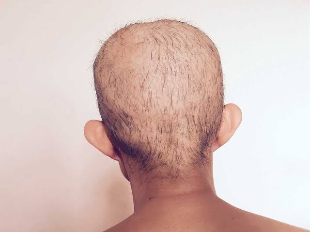 modernHealthMe's tweet image. patient with sudden loss of hair after chemotherapy.
What happened?