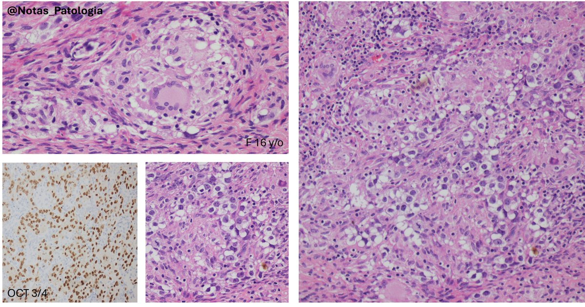 🧬 DYSGERMINOMA WITH EXUBERANT GRANULOMATOUS REACTION: AN UNDERESTIMATED DIAGNOSTIC CHALLENGE

Dysgerminoma is the most common malignant germ cell tumor of the ovary, considered the female counterpart of testicular seminoma and central nervous system germinoma. It usually shows a