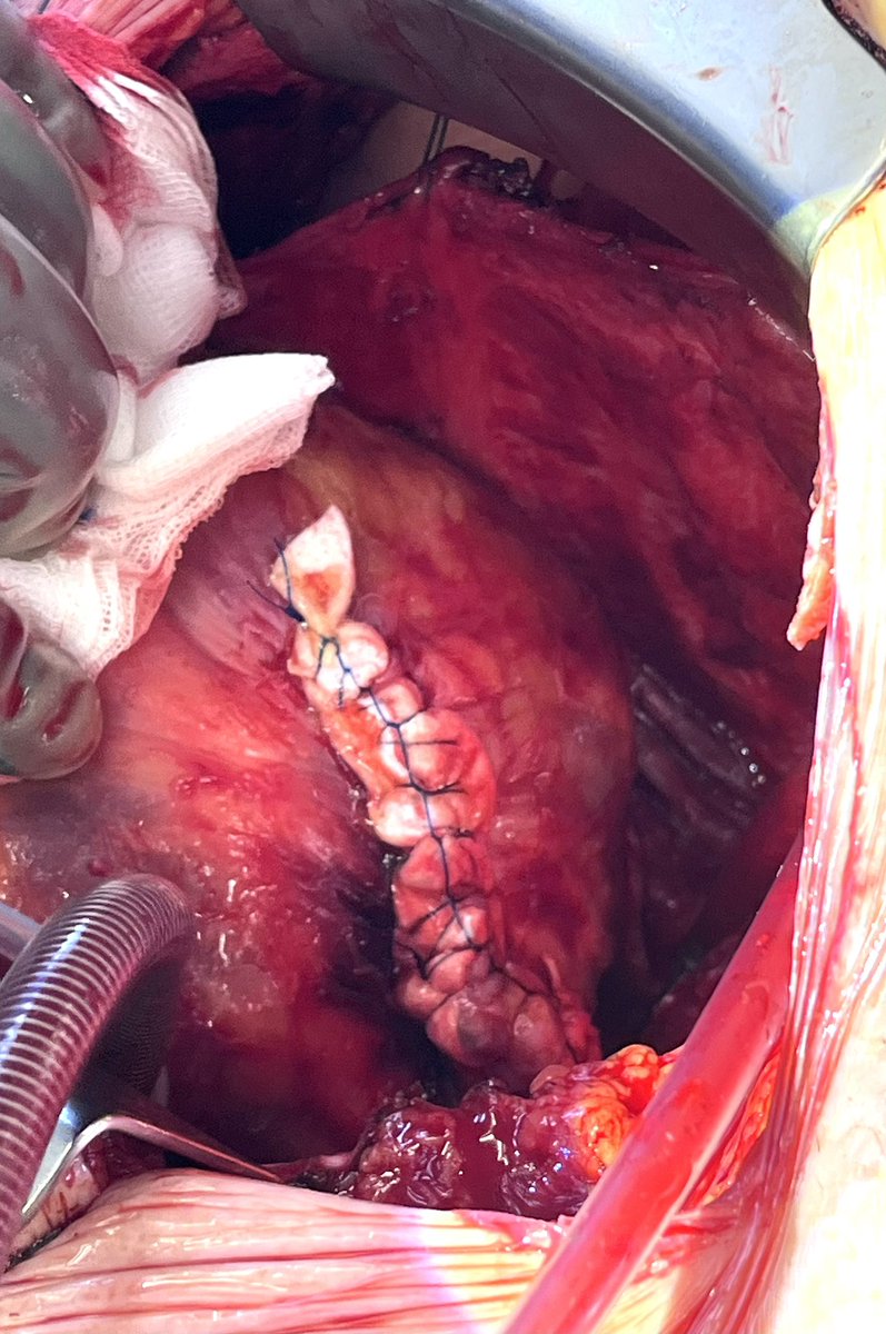 Another complex cardiac surgery case in Harburg: Dorplasty, LV reconstruction, and 2× CABG. 💪🫀
#CardiacSurgery #Dorplastic #CABG <a href="/asklepiosklinik/">Asklepios</a>