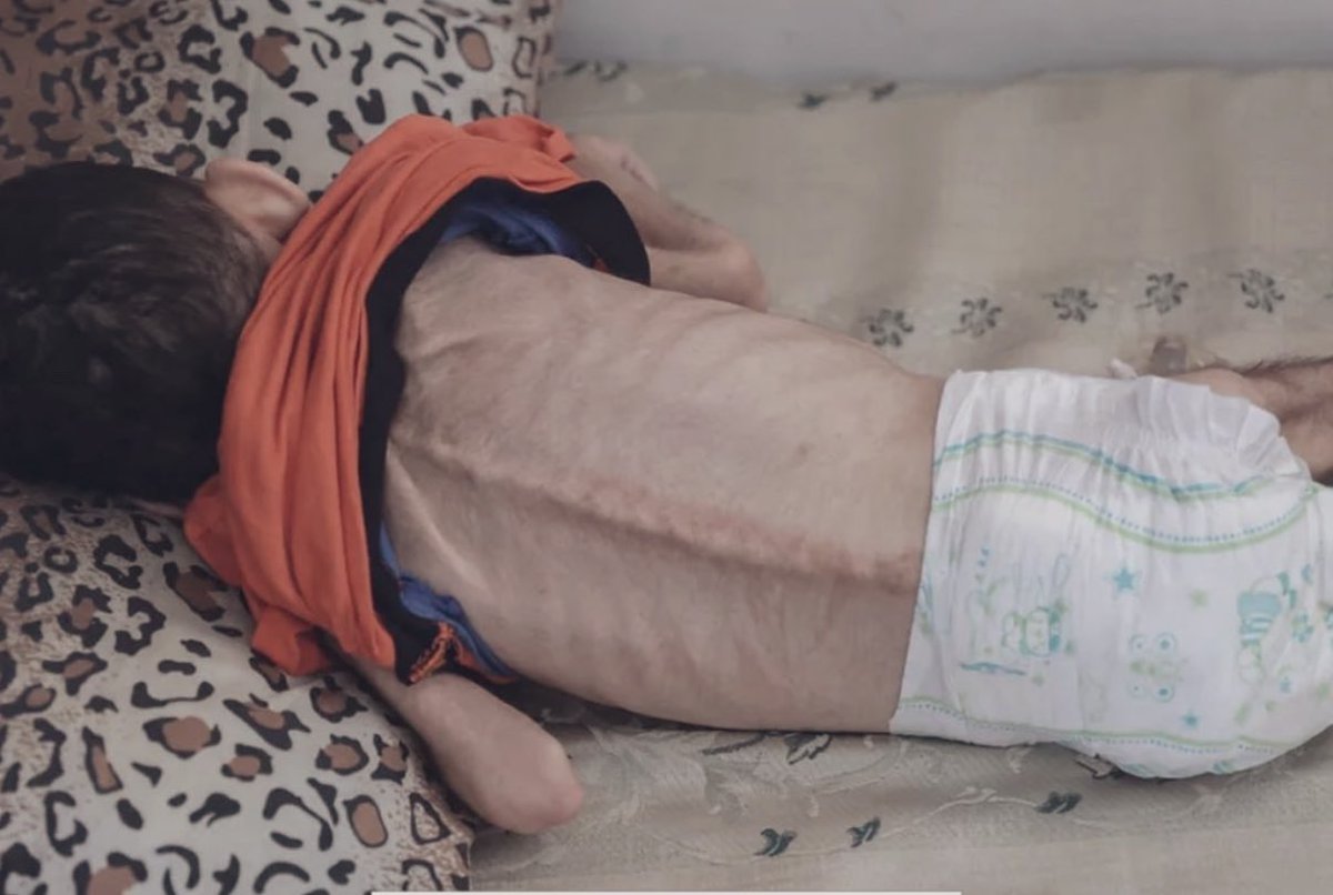 fadiquran's tweet image. Kids by the thousands are starving to death. This is what that looks like. Air drops with spaghetti and canned beef won’t save them - allowing all foods in, allowing more doctors in with medical grade nutritional supplements will. All else=theatre. 10,000 trucks must enter now!