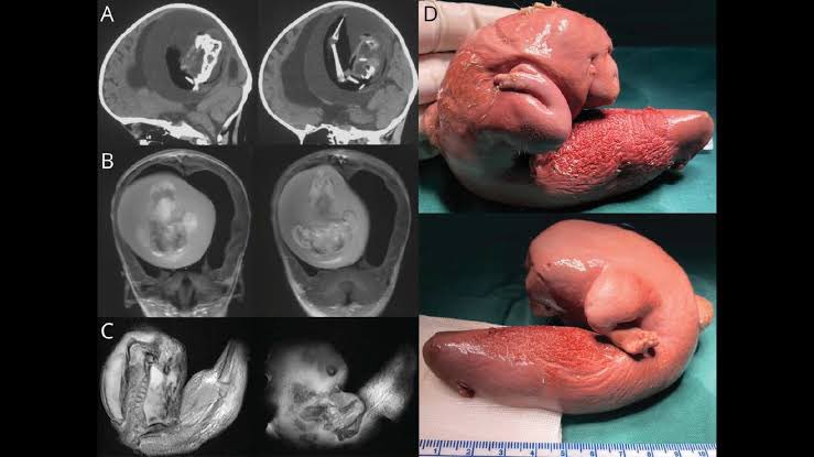 TheKoshurDoc's tweet image. FETUS IN FETU (FIF)
is a rare condition where a deformed twin develops inside a living child or newborn. It is very rare with fewer than 200 cases documented.
1st pic:
A man pregnant in his 30s with his twin.
2nd pic:
A twin inside the brain
#MedTwitter @IhabFathiSulima