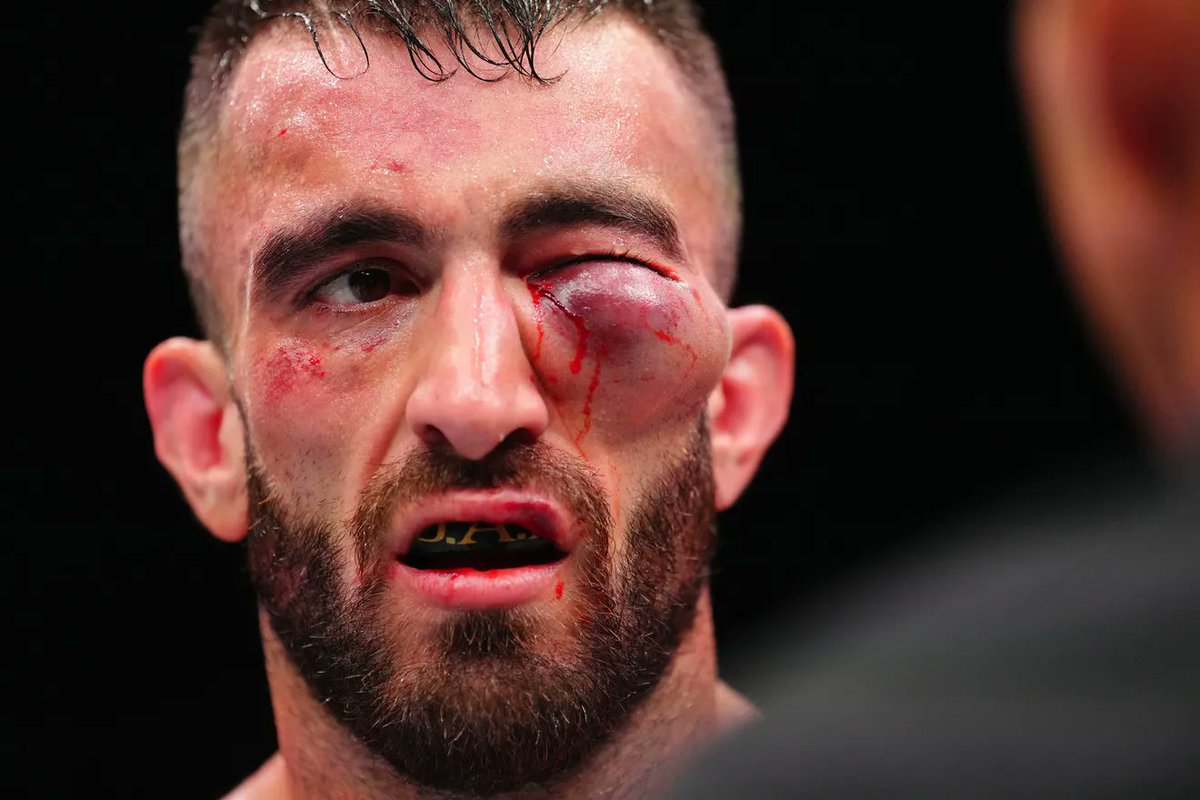 InTheCagePL's tweet image. 🚨Sześciokrotne liczenie, złamany nos i operacja oka... Troje zawodników trafiło wczoraj do szpitala po brutalnej gali #UFCAbuDhabi.
Czytaj więcej: inthecage.pl/trzech-zawodni…
foto: Zuffa LCC, screen UFC Fight Pass