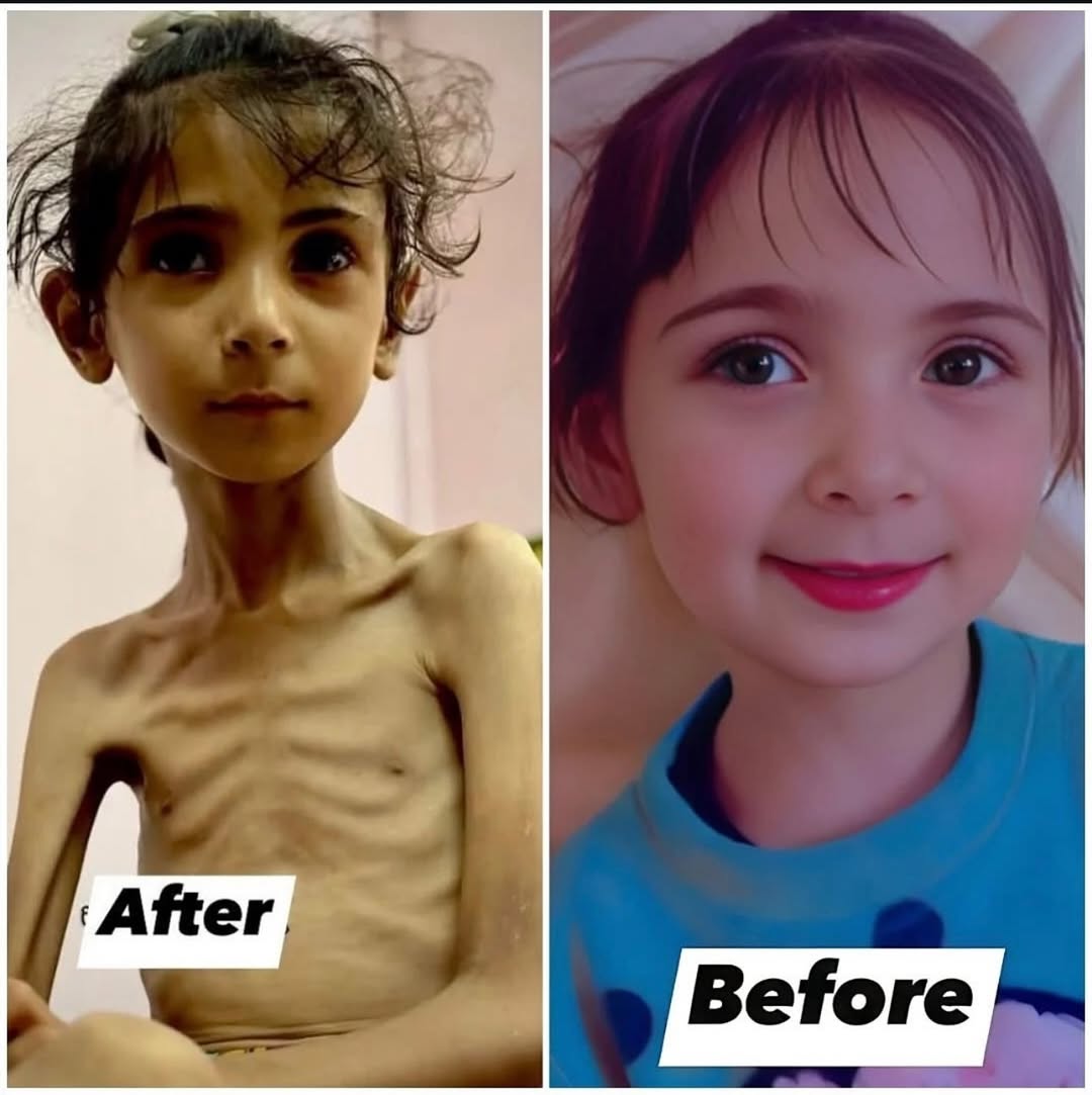 أطفال غزة لا يكبرون.. بل يذبلون تحت وطأة الحصار.
وجوه شاحبة، أجساد نحيلة، وعيون غائرة تنتظر بصمت كسرة خبز أو جرعة حليب.
في ظل حصار خانق ومساعدات محاصرة،
تتفاقم الأزمة الإنسانية يومًا بعد يوم، ويزداد عدد الأطفال الذين يعانون من سوء التغذية ونقص الغذاء الحاد.
#غزه_تموت_جوعاً