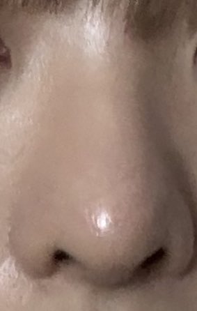 鼻整形してから5ヶ月過ぎたくらい！
めちゃくちゃ満足してて、高さはあるけど正面から見たらナチュラルで、本当に理想通りにしていただきました🥲(写真見ずらくてごめんなさい)
質問したらすぐ答えてくれるしカウセもめっちゃ丁寧で半年間あまり不安にならずに過ごせた！！ありがとうございました⭐️