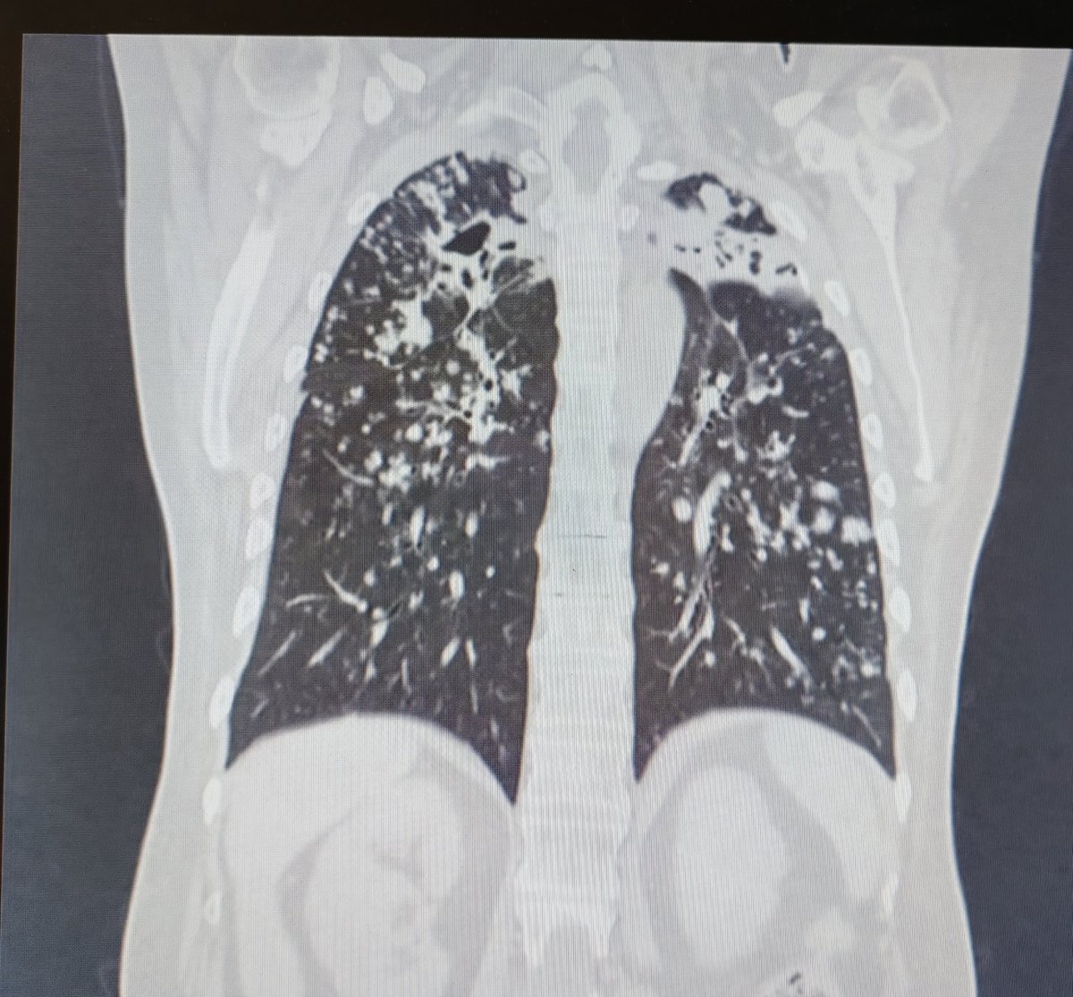 moy_qmac's tweet photo. Mujer de 62 años con tos crónica, en episodios productiva que empezó hace 1 mes con hemoptisis.

Es hospitalizada donde realizan TAC, broncoscopia y toman biopsias.

La TAC es la siguiente.... https://t.co/2Q9kpXjg3a