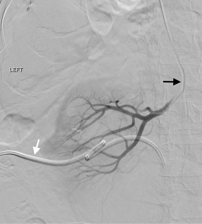 CVIR_Journal's tweet image. #tb to 2023! 🔙
Transradial Catheterization in the Prone Position: A Technique that Simplifies Complex Post-procedural Renal Intervention for Patients Undergoing Renal Angiography for Nephrostomy-Related Hemorrhage
link.springer.com/article/10.100…