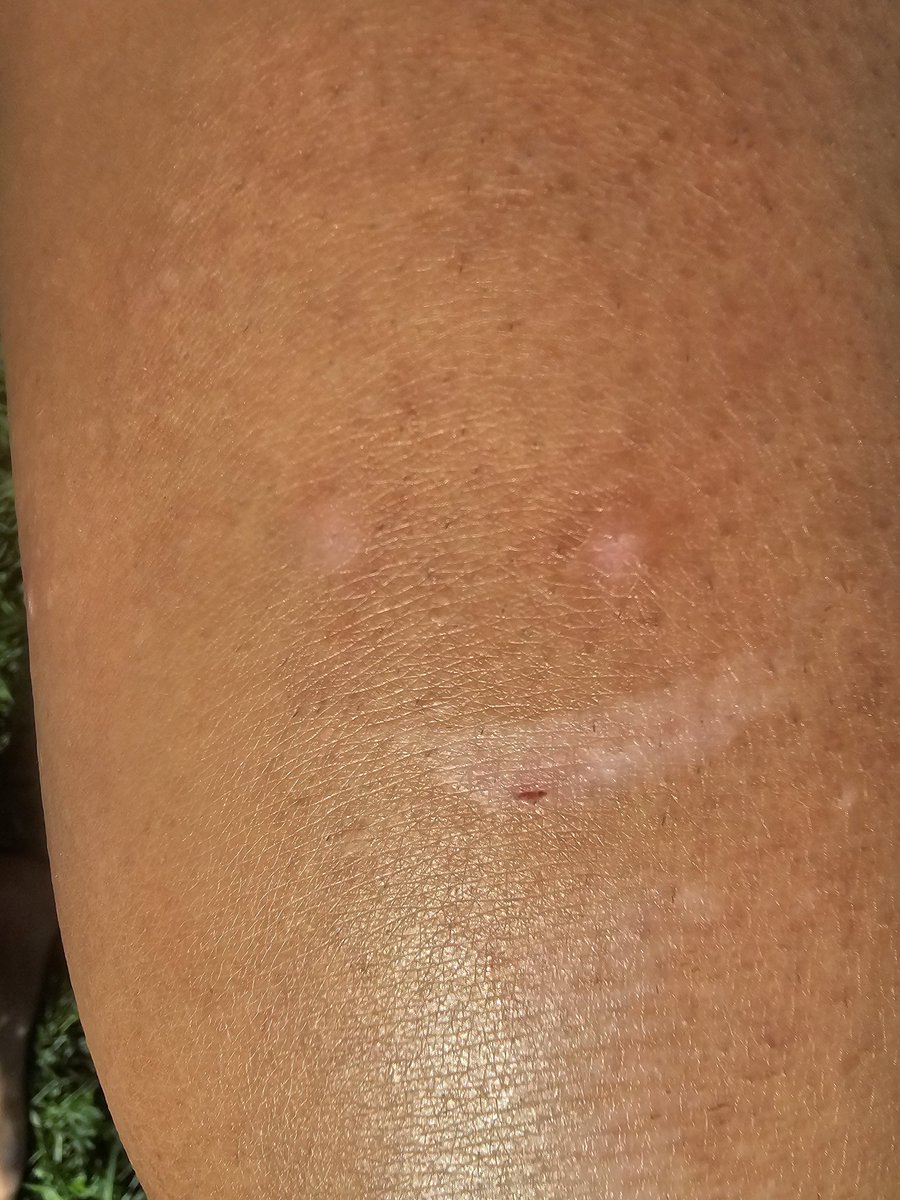 sarah_b_ware's tweet image. They say scars tell a story... I guess this one is a happy story.
