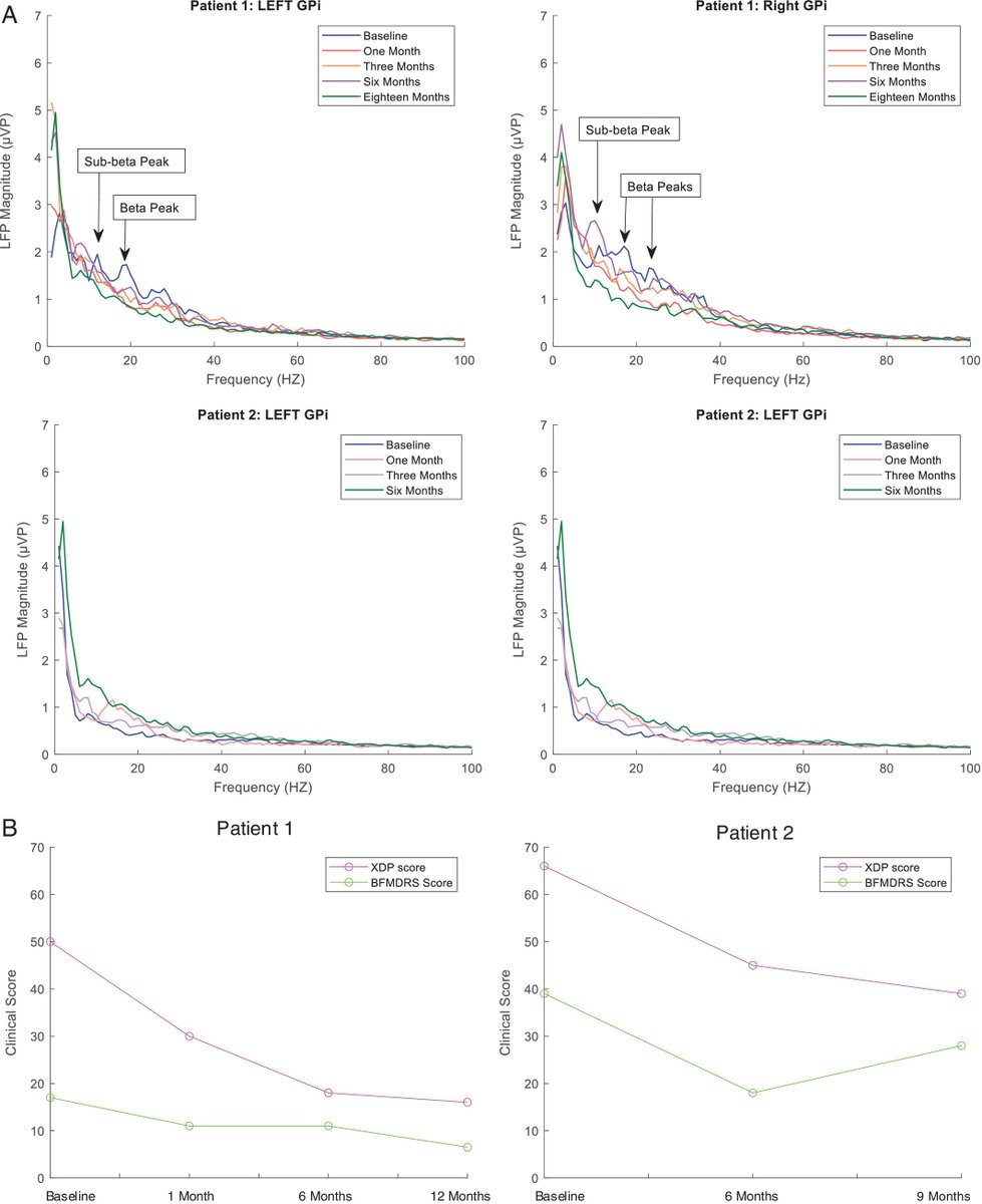 New report by Donlon et al on GPi DBS for X-linked dystonia parkinsonism (DYT3) on 2 patients. Electrophysiologic characterization noted to vary with the phenotype but both responded to neuromodulation. Great videos too!

…mentdisorders.onlinelibrary.wiley.com/doi/10.1002/md…