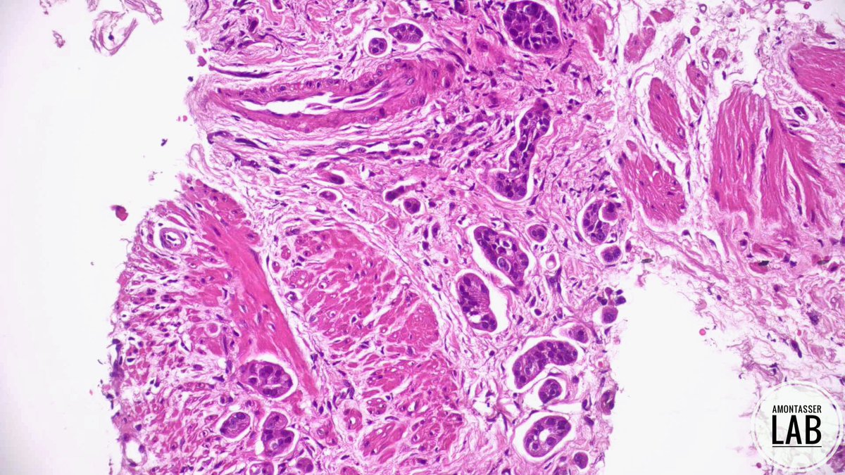 AMontasserMD's tweet image. Impressive cellblock material from such a small lesion [12mm periampullary mass] ❗️

It takes 2️⃣ to tango and it takes 3️⃣ to EUS; endoscopist, path assistant and pathologist 🫱🏻‍🫲🏽 

#GIpath #Pathology #PathX