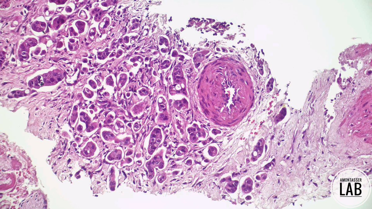 AMontasserMD's tweet image. Impressive cellblock material from such a small lesion [12mm periampullary mass] ❗️

It takes 2️⃣ to tango and it takes 3️⃣ to EUS; endoscopist, path assistant and pathologist 🫱🏻‍🫲🏽 

#GIpath #Pathology #PathX