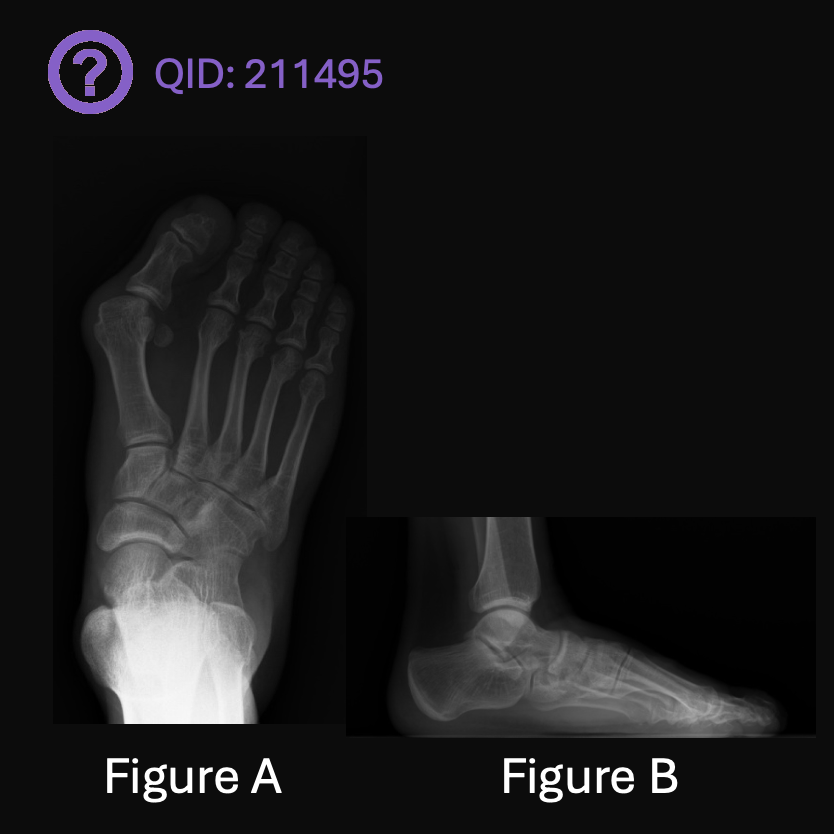 orthobullets's tweet image. Can you answer our FREE Question of the Day?
A 50-year-old male presents with a painful medial right forefoot over the past 3 years. He has had progressive pain and difficulty wearing shoes for his occupation. His radiographs are shown in Figures A and B. He undergoes surgical…