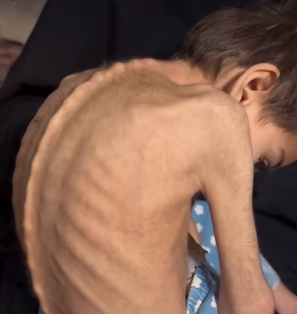 من غزة الآن حيث الجوع ينهش اجساد الأطفال 🇵🇸