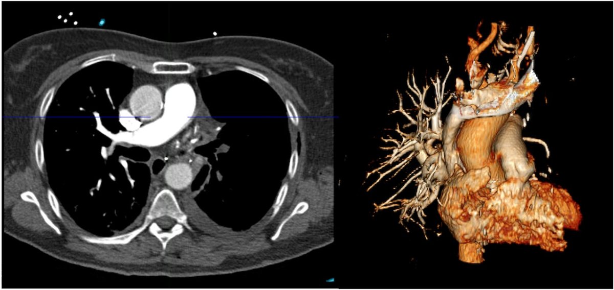 JACCJournals's tweet image. 61F developed acute dyspnea and hypoxemia 72 hours after open lung lobectomy. An urgent CT angiography revealed an acute pulmonary embolism with complete left pulmonary artery occlusion. jacc.org/doi/10.1016/j.… #JACCCaseReports #IVUS