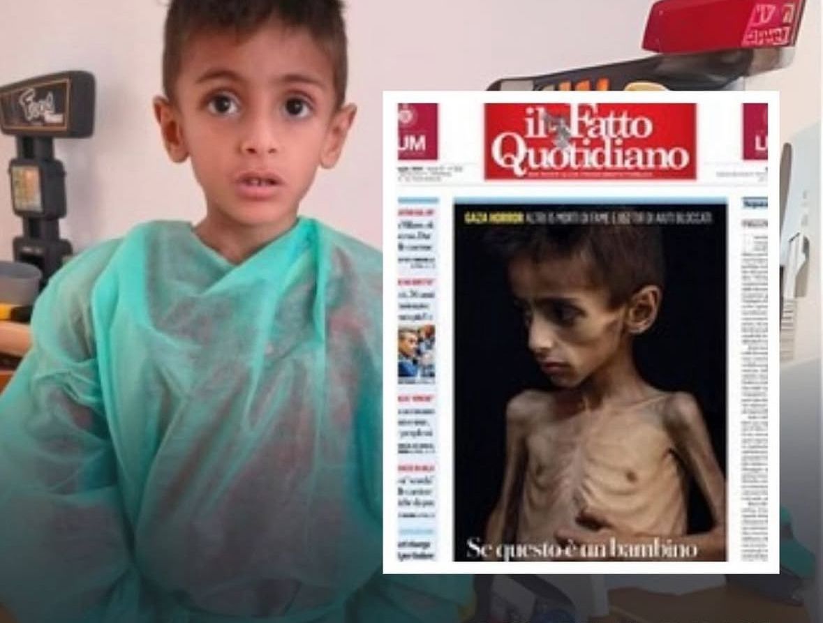 A photo of a starving child in Gaza on the cover of a newspaper in Italy 🇮🇹 

Except that it wasn’t. 

Osama Al-Rakab left Gaza for Italy for treatment for his cystic fibrosis. 

His treatment was coordinated directly with the Italian Foreign Ministry. 

This story should not be