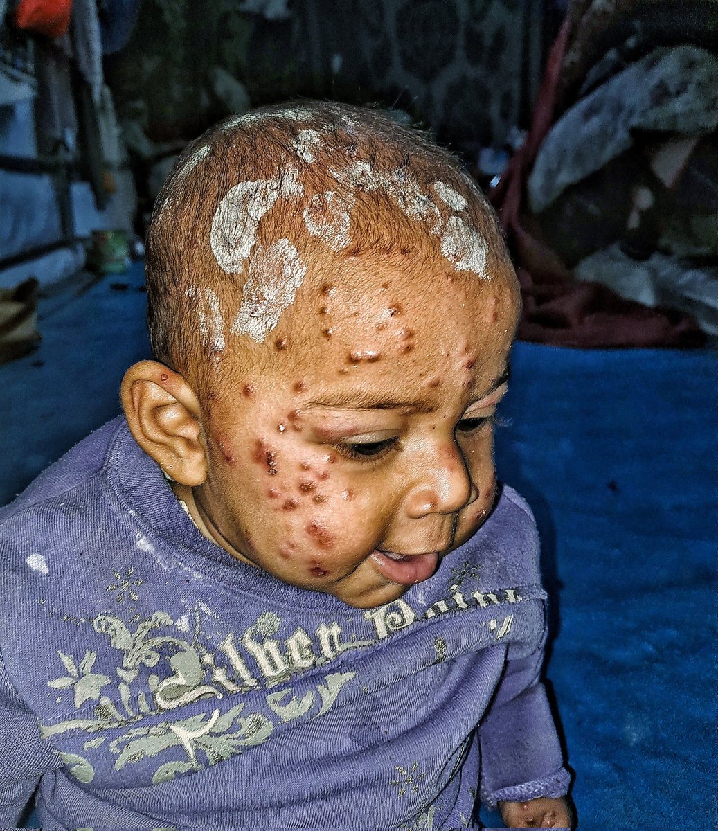 Tasneem is the most precious thing I have. She has severe pimples on her face because of the changeable weather. It causes her severe discomfort. And constant crying. Because of the pain. And because of hunger. Tasneem finds no comfort. The pain is merciless, and the burning does